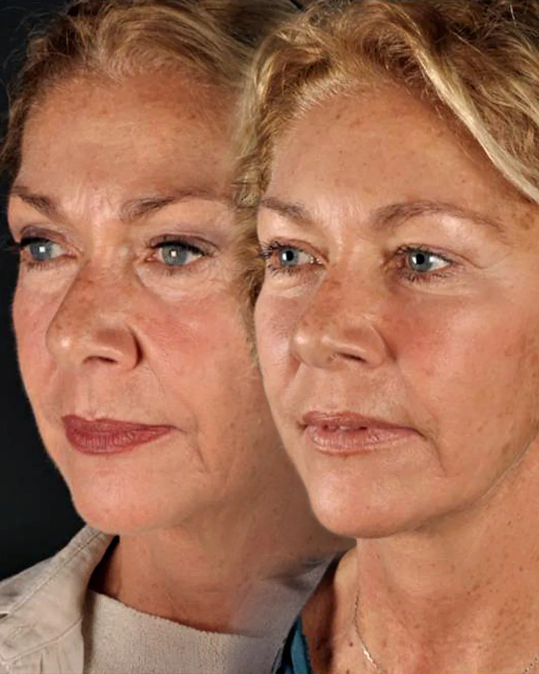 Facelift