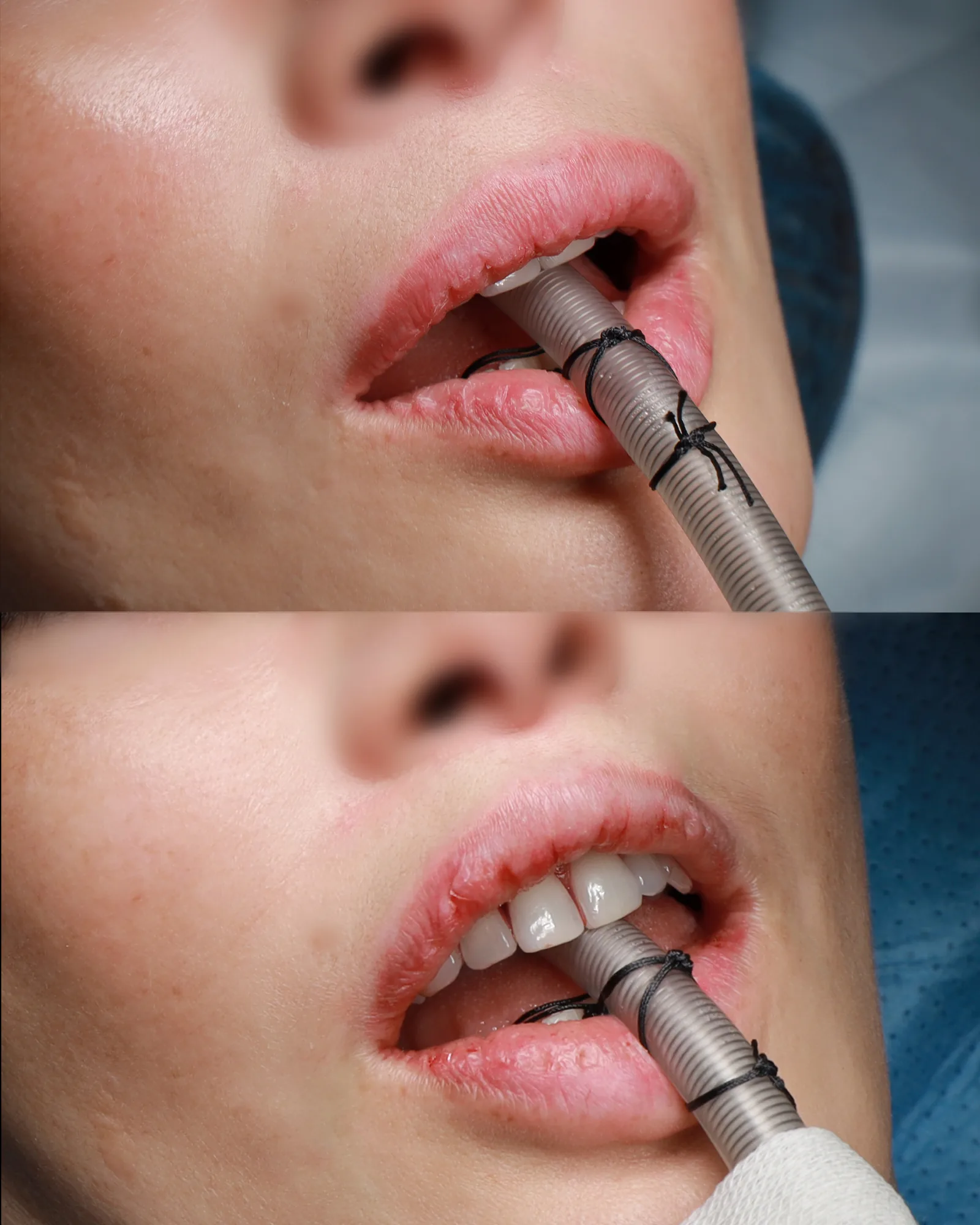 Scarless Liplift