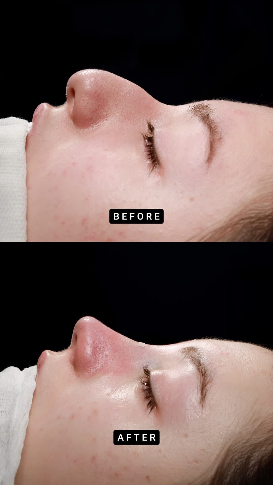 Primary Teorhinoplasty 👃